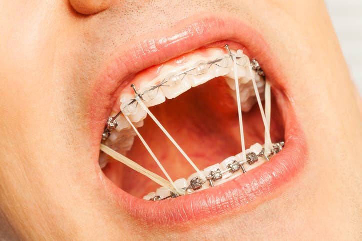 18 Photos That Only People Who Had Braces Will Understand Buzzfeed's popular quizzes get tens of millions of shares. only people who had braces will understand