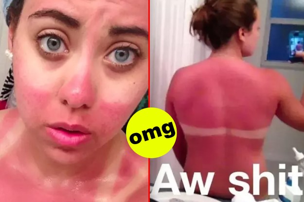 Show Us Your Most Ridiculous Sunburn