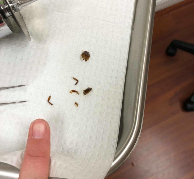 When she got to the hospital, she was seen right away by a doctor, who used lidocaine to both numb her ear and kill the bug.