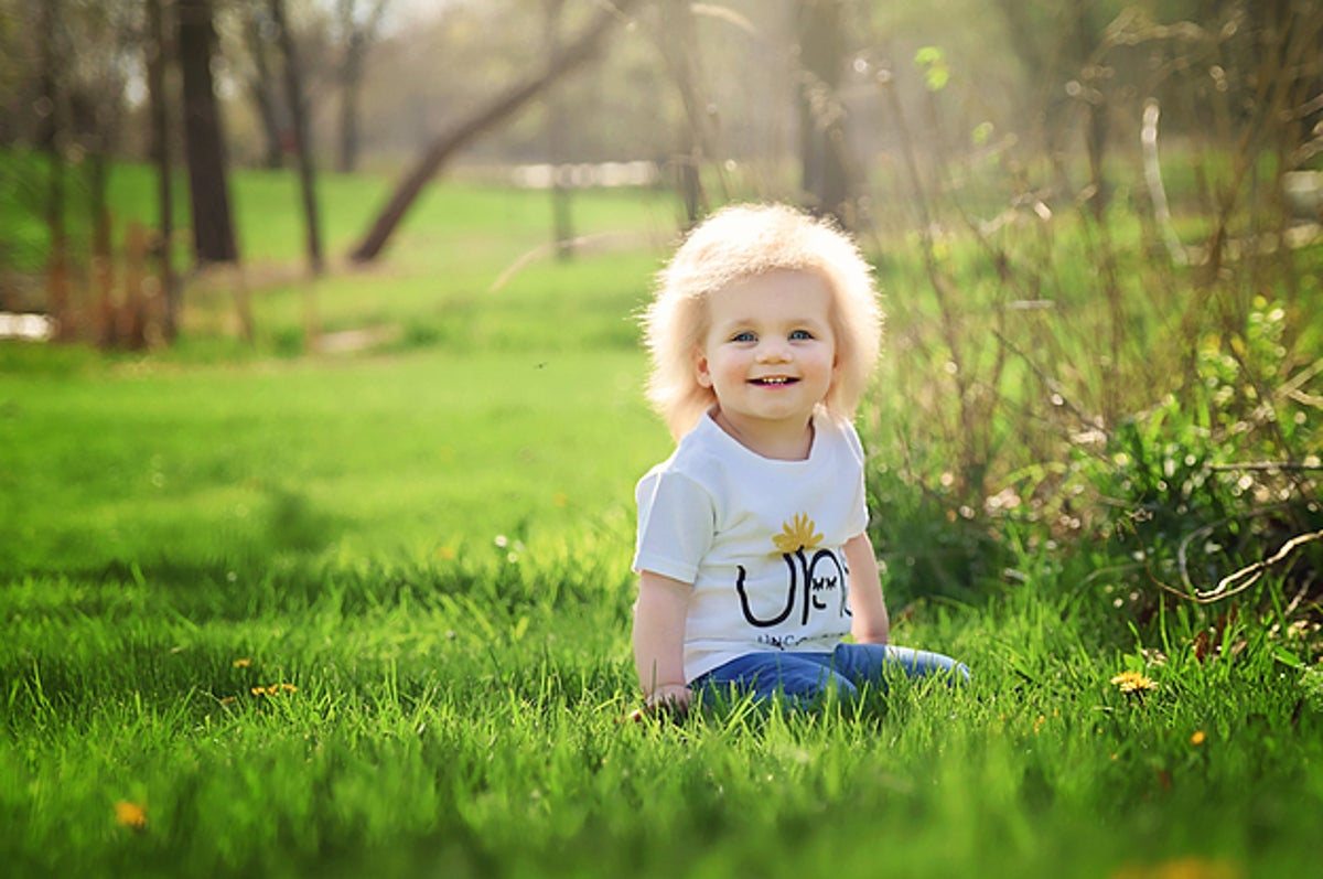 Uncombable Hair Syndrome Is A Real, Super-Rare Genetic Condition And This  Baby Has It