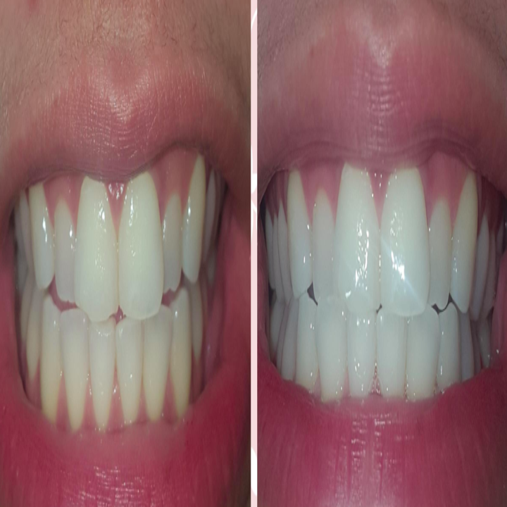 15 Amazing Teeth Whiteners People Actually Swear By