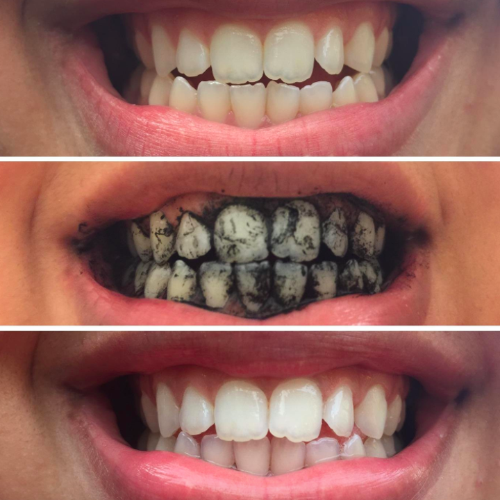 15 Amazing Teeth Whiteners People Actually Swear By