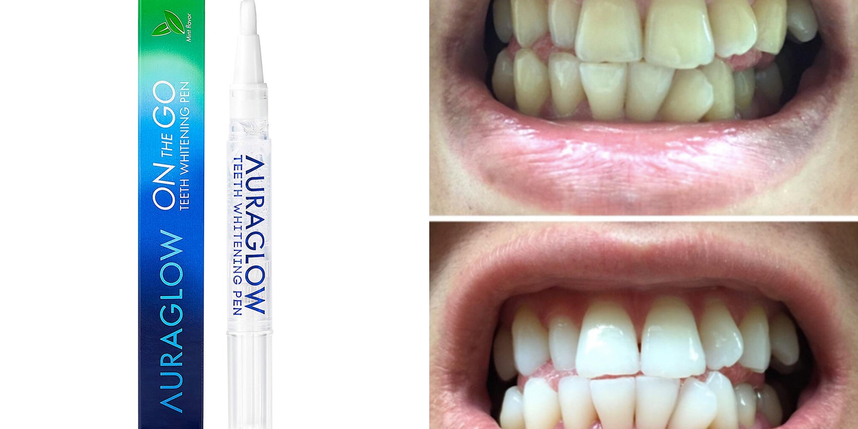 Can You Use Crest White Strips While Pregnant لم يسبق له مثيل