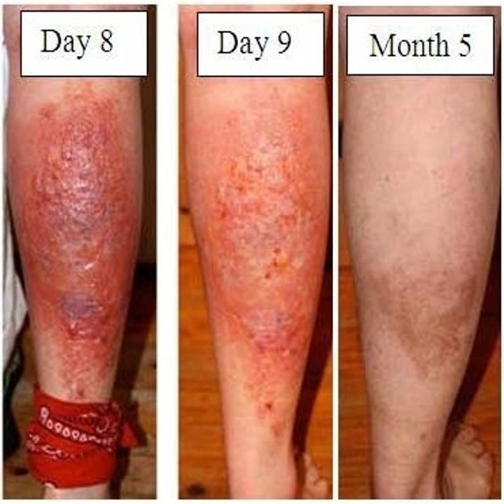 Giant Hogweed, The Plant That Causes Burns And Permanent Blindness, Is