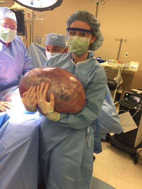 A Woman With A 50Pound Ovarian Cyst Was Initially Told To