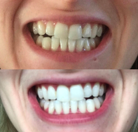 crest white strips noticeably white reviews