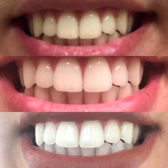 before/after of person&#x27;s teeth with after photo showing noticeably whiter teeth