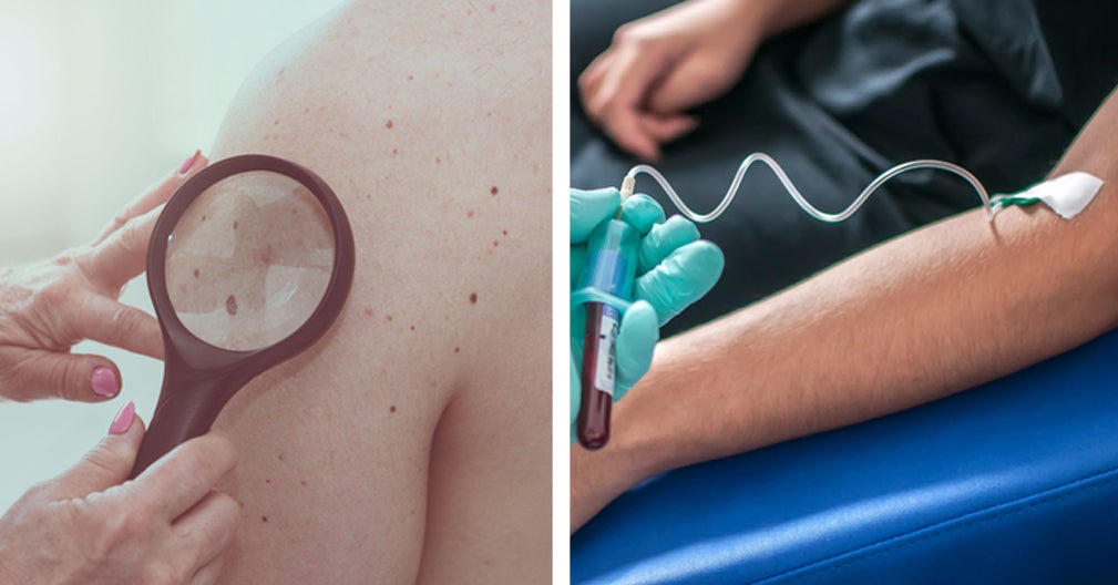 This New Test Could Change How We Detect Skin Cancer