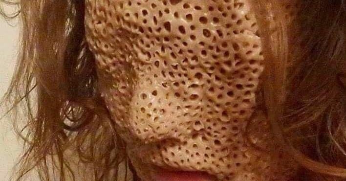 Trypophobia Löcher In Der Haut