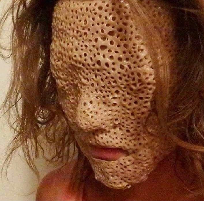 Trypophobia Löcher In Der Haut