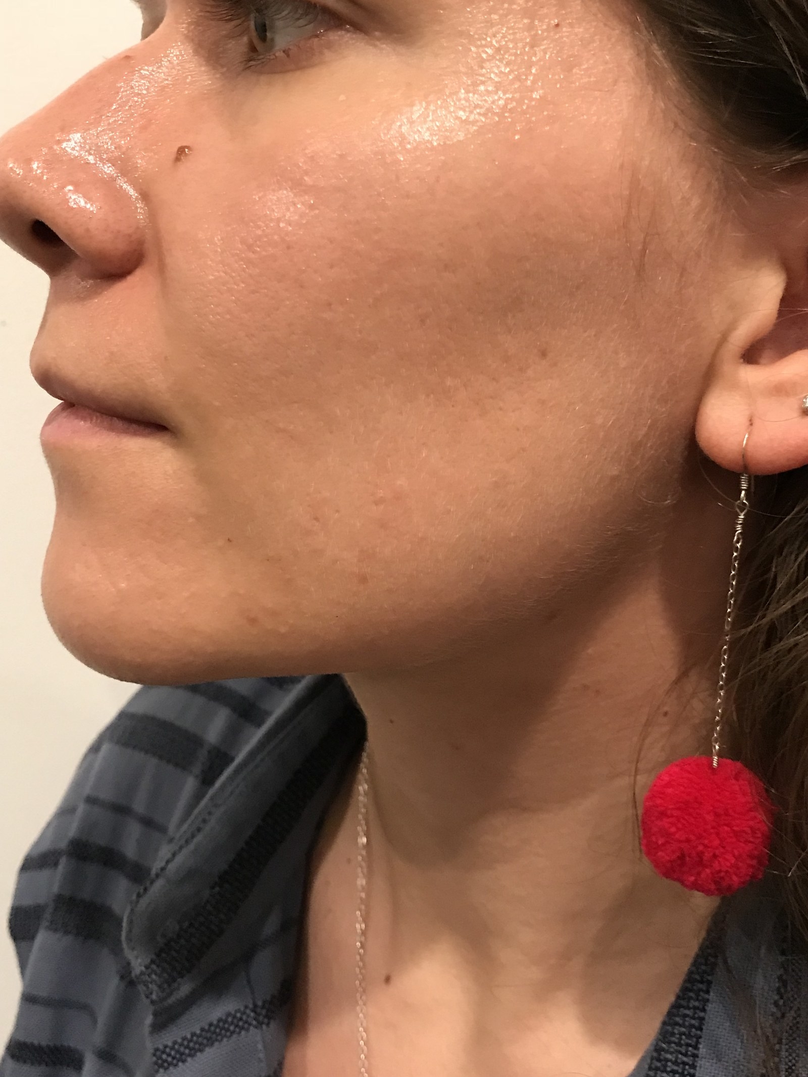 the ordinary peeling solution closed comedones