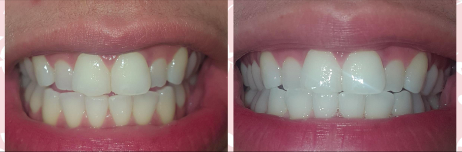 50+ Teeth Whitening Pen Before And After Images