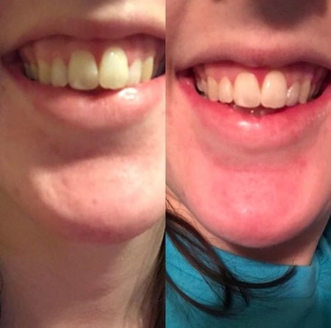 24 Of The Best Teeth Whiteners That You Can Get Online In 2018