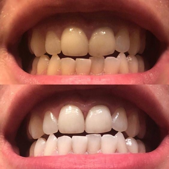journalist Dejlig tweet 24 Of The Best Teeth Whiteners That You Can Get Online In 2018