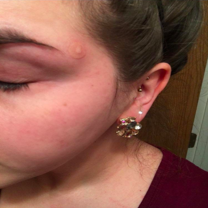 33 Ways To Help Get Rid Of A Pimple In A Hurry