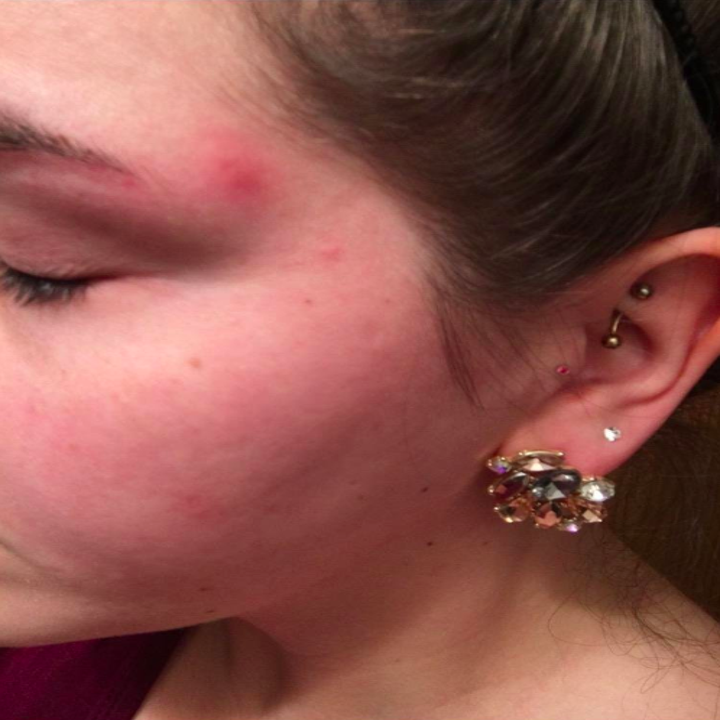 33 Ways To Help Get Rid Of A Pimple In A Hurry