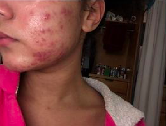 treeactiv spot treatment