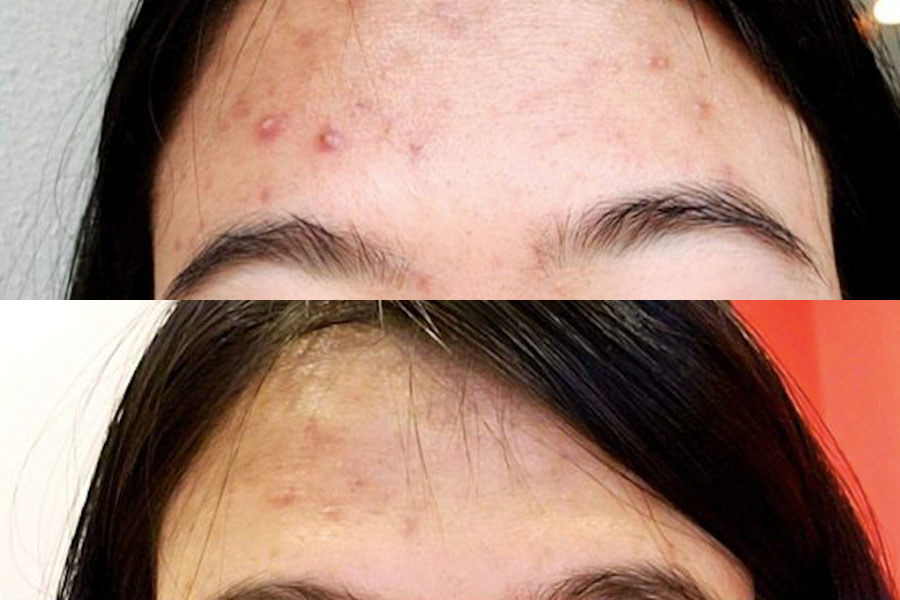 Hundreds Of People Swear By This Spot Treatment For Cystic Acne