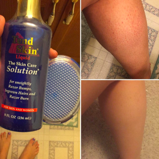 A reviewer&#x27;s collage of photos. On the left, a bottle of the product and an exfoliating brush. On the top right, their leg with lots of razor bumps. On the bottom right, the same leg looking smooth