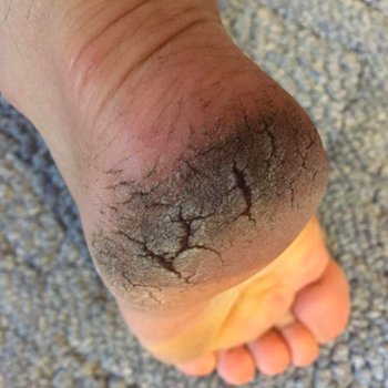 A reviewer's heel looking dirty and deeply cracked