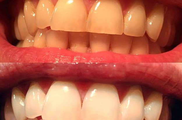 Wallpaper Teeth Aligners Over The Counter Walmart Teethwalls Free