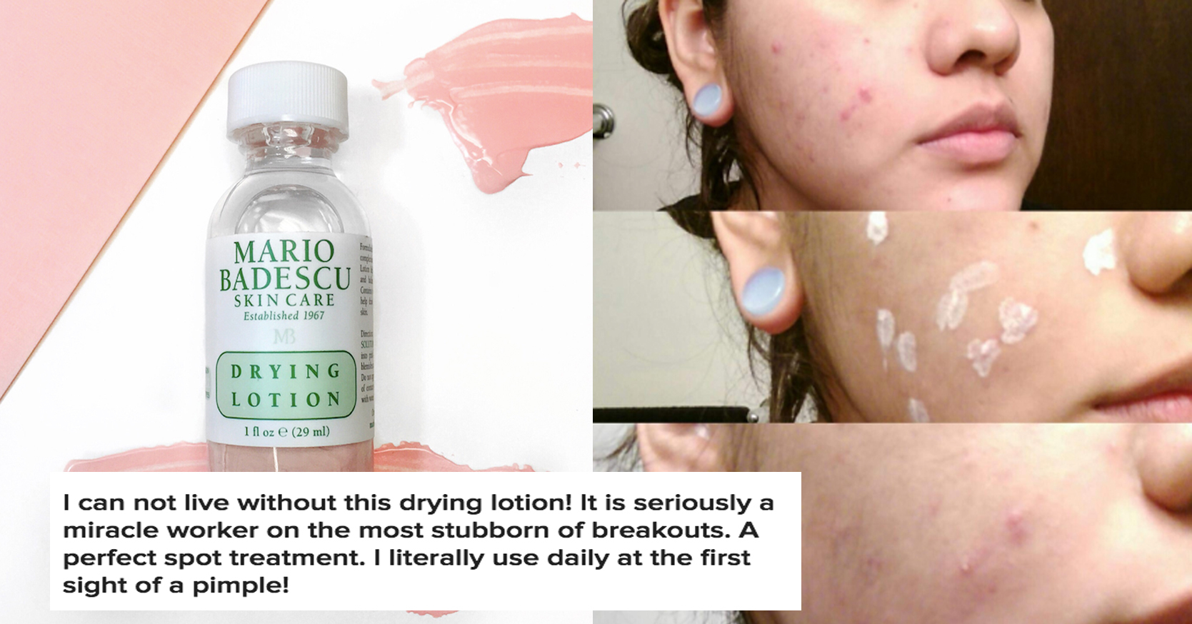 This Miraculous Lotion Dry Up All Your Juicy Pimples ASAP