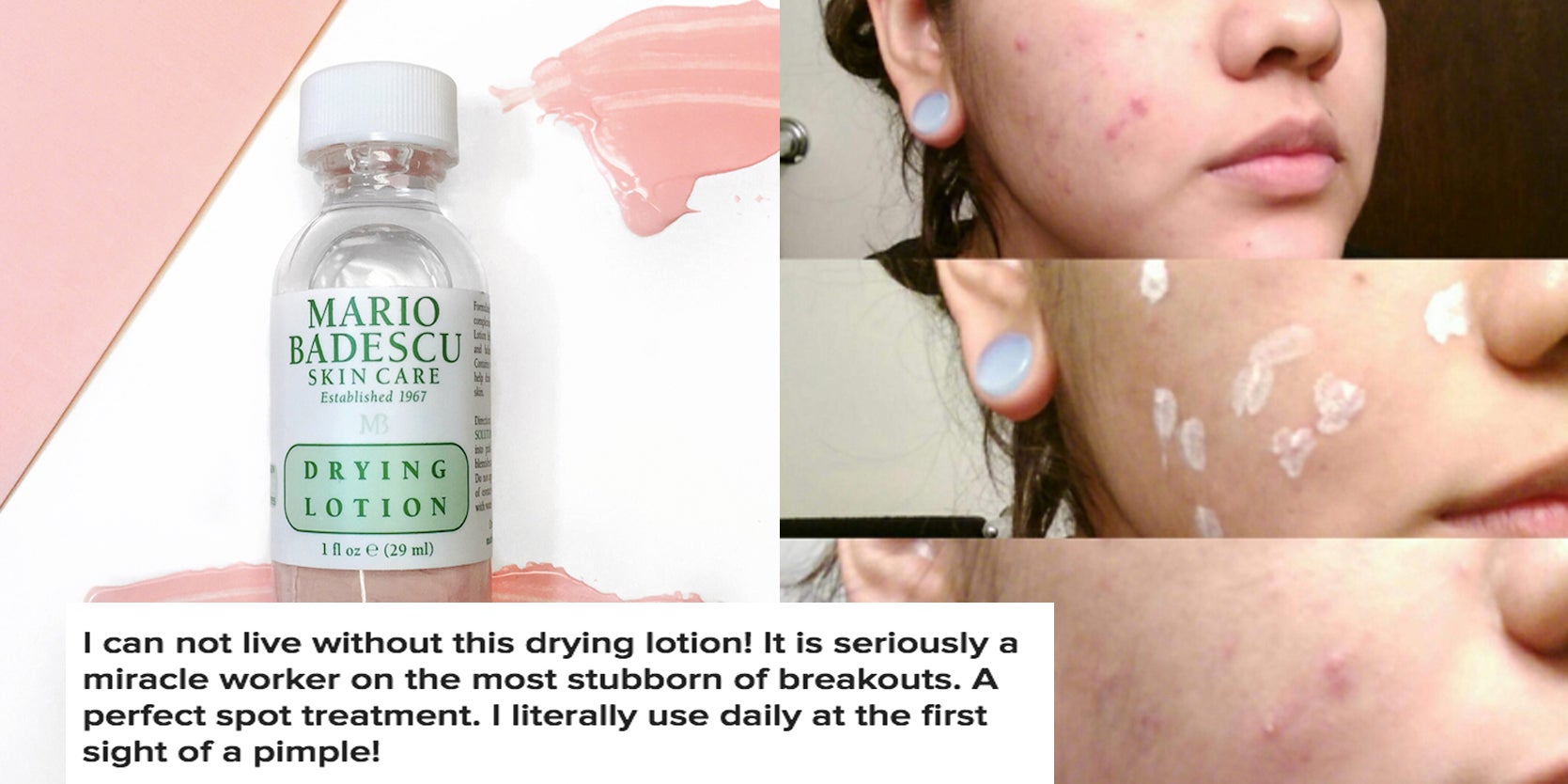 This Miraculous Lotion Dry Up All Your Juicy Pimples ASAP