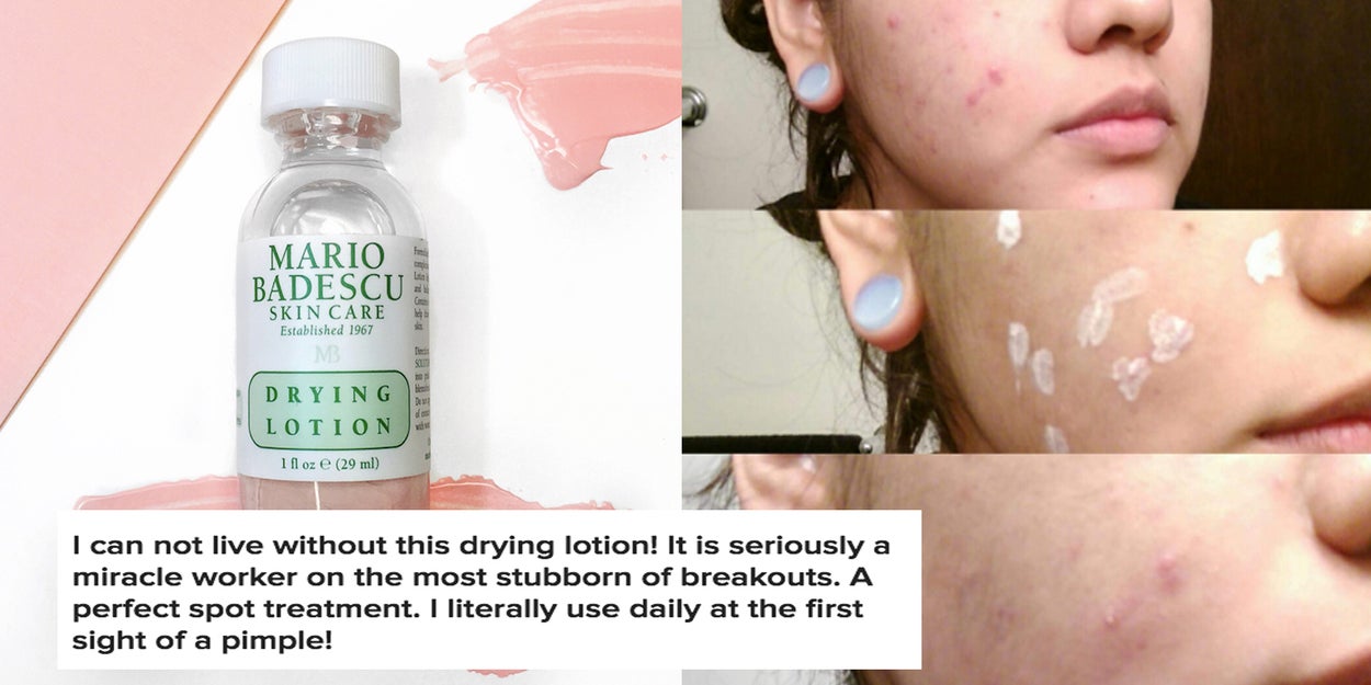 This Miraculous Lotion Will Dry All Your Pimples ASAP