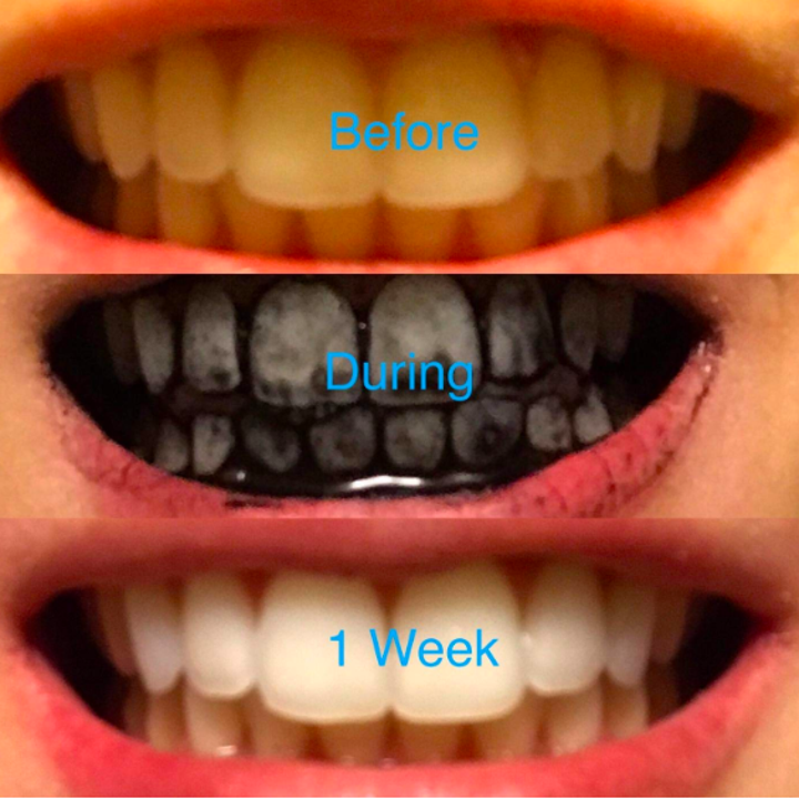 24 Of The Best Teeth Whiteners You Can Get On Amazon