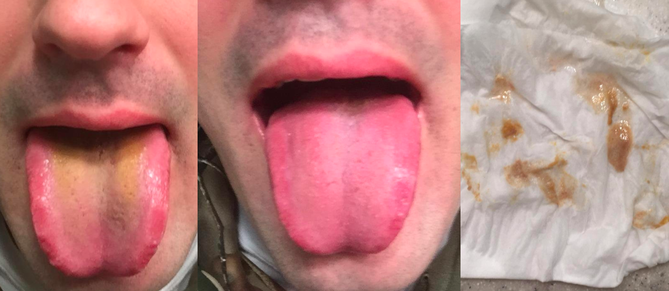 Tongue scrapers do 'no harm,' possibly some good