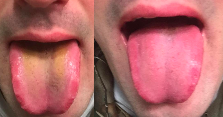 This Stainless Steel Tongue Scraper Is Gonna Make Your Stinky-Ass ...