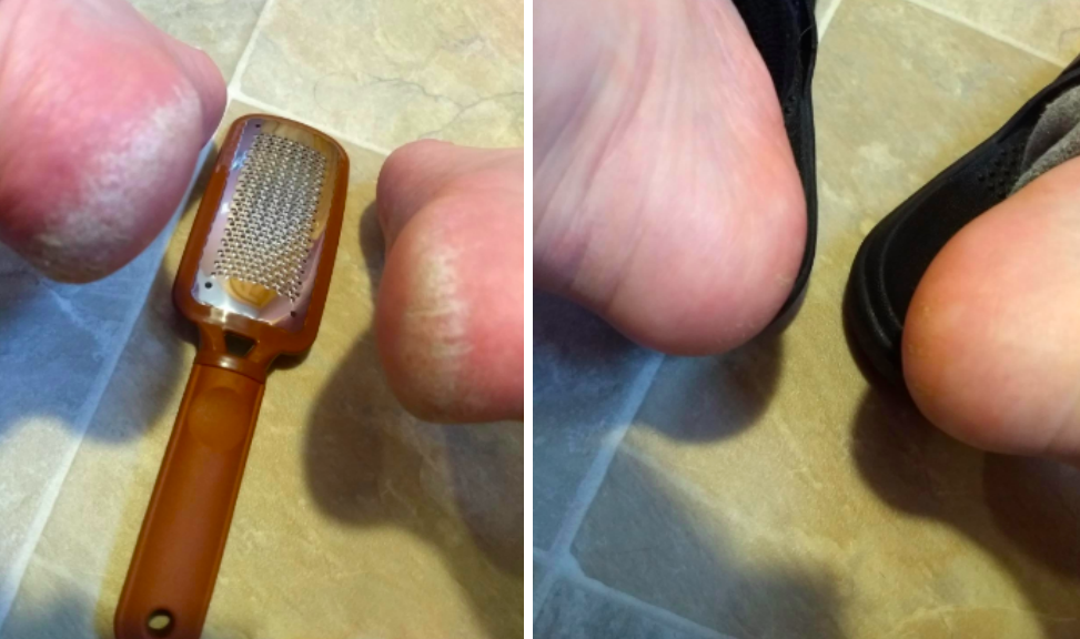 Stop Cheese-Grating Your Feet, Folks