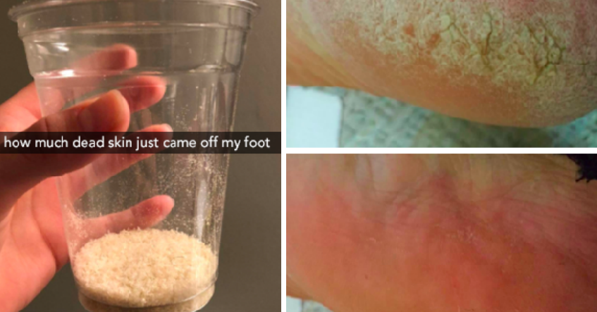 Cieken Ped Egg Callus Hard Skin Remover Pedicure Beautiful Feet