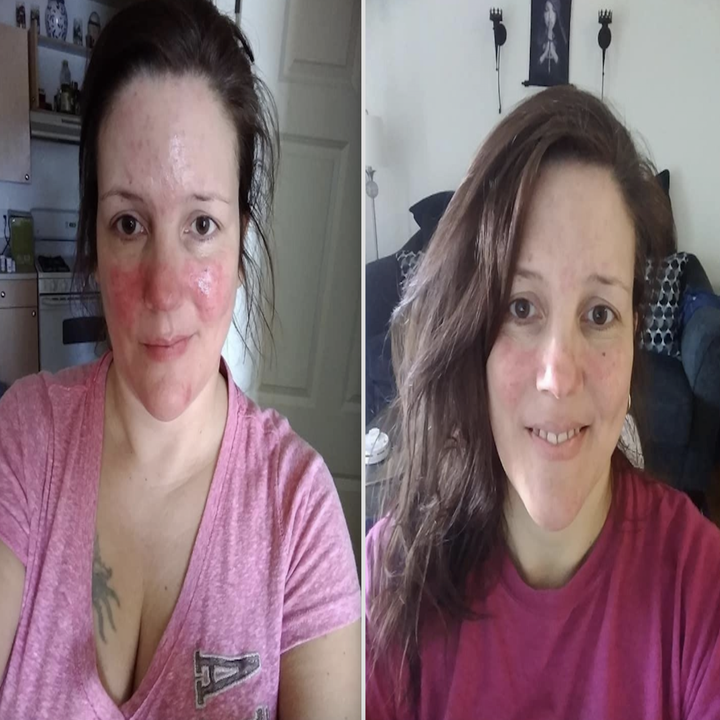 reviewer before and after photo showing how the tea tree oil reduced redness on their face