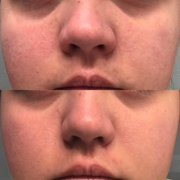 reviewer before and after showing how the cream cleared up their skin