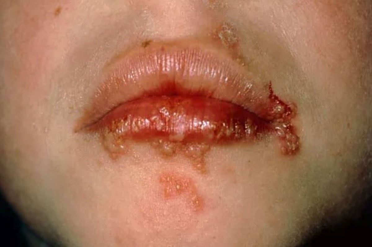 Here S What You Need To Know About Cold Sores And Herpes