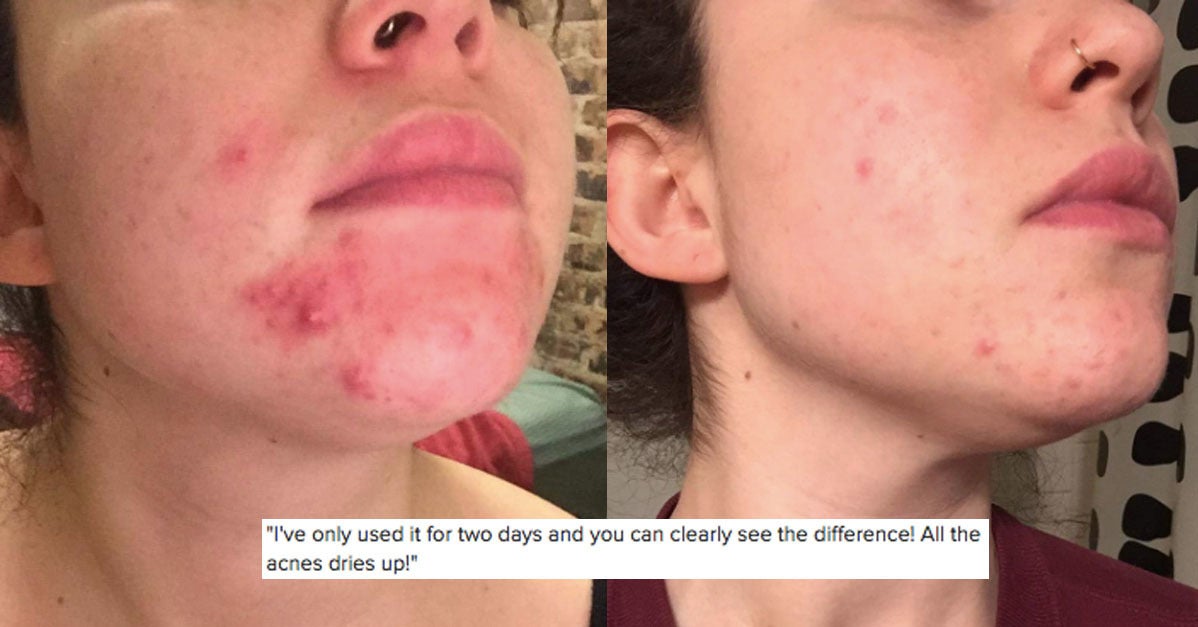 29 Things For Anyone Who's Seriously Done With Breaking Out