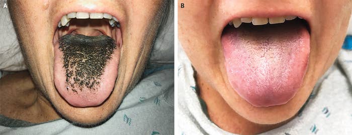 A Man's Eyes Were Stained Blue After He Took An Antibiotic To Treat Inflammation