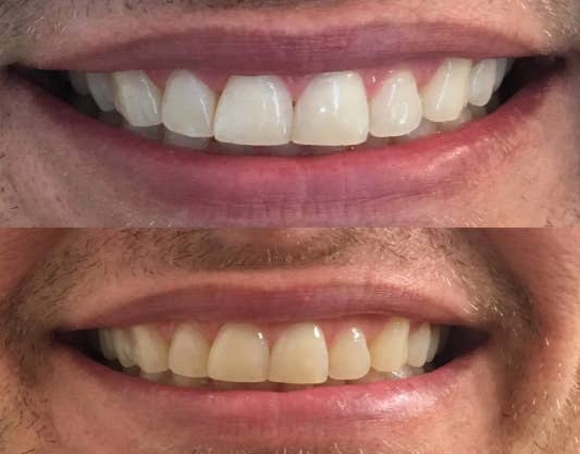 a reviewer's after pic, with white looking teeth, and before pic, with yellower-looking teeth