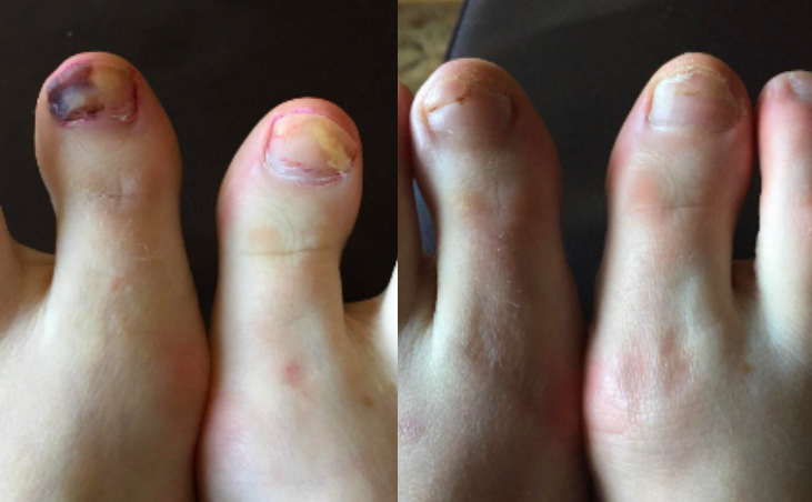 Reviewer&#x27;s big toes with dark and light spots of fungal growth before. The toenails are growing back and looking healthier after use. 