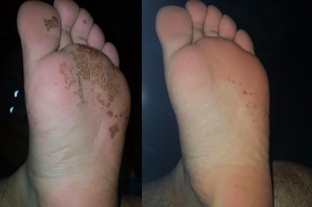 painful crack on ball of foot