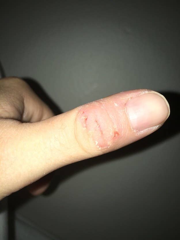 finger skin picking