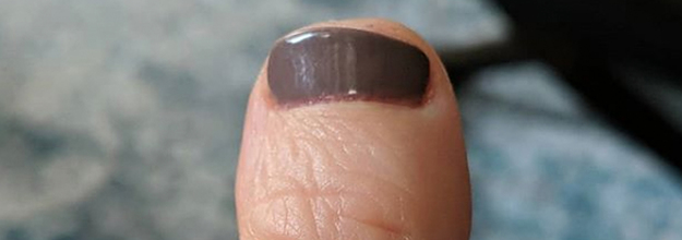 19 Things You'll Only Understand If You Have Clubbed Thumbs