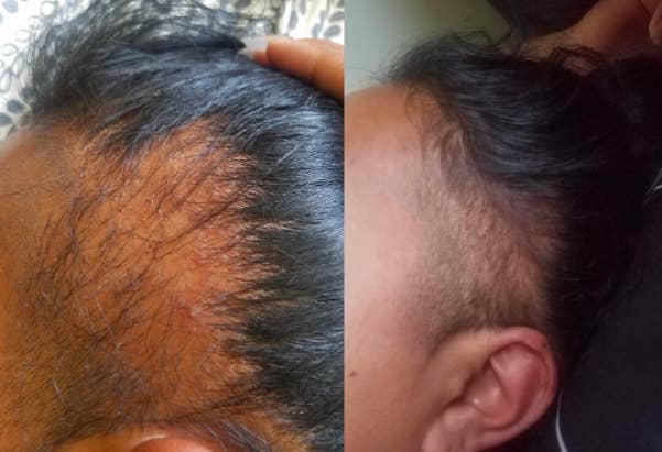 Zinc hair growth results