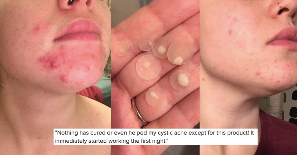 These 26 Things Fix Breakouts And We Have The Proof