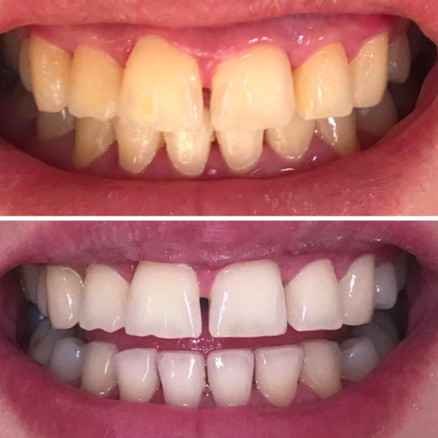 Its main ingredients are charcoal (yeah) and bentonite clay. Promising review: "I have only used the Pro Teeth Whitening Activated Charcoal Powder for two days (twice a day as directed), and already see a significant difference! Not only are my teeth extremely white, but there is no hot/cold tooth sensitivity like I have had with many major brand whitening systems. My teeth also feel like they have a smooth polished texture exactly like they feel after leaving my six month dental deep cleaning appointments." —DestinyGet it from Amazon for $13.99.See what won our top picks for teeth whiteners on BuzzFeed Reviews.
