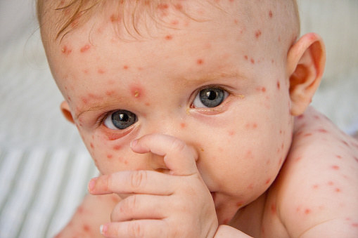 A Chickenpox Outbreak Has Hit A North Carolina School With High Vaccine ...