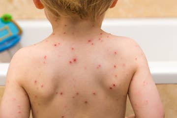 A Chickenpox Outbreak Has Hit A North Carolina School With High