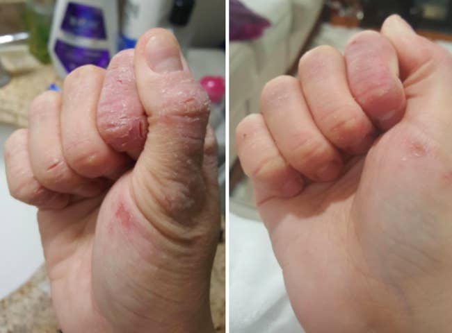 A before-and-after of a reviewer's very dry hand with many cracks and small cuts compared to a much softer and smoother looking hand with only a couple small dry spots left 