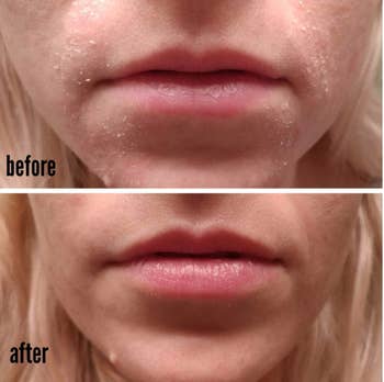 Before: a reviewer with a very peeling chin and upper lip; After: the same reviewer, with no more peeling